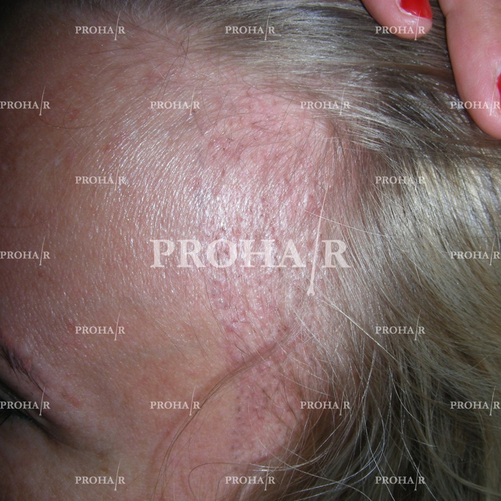 PROHAIR International Hair Transplant Klinika